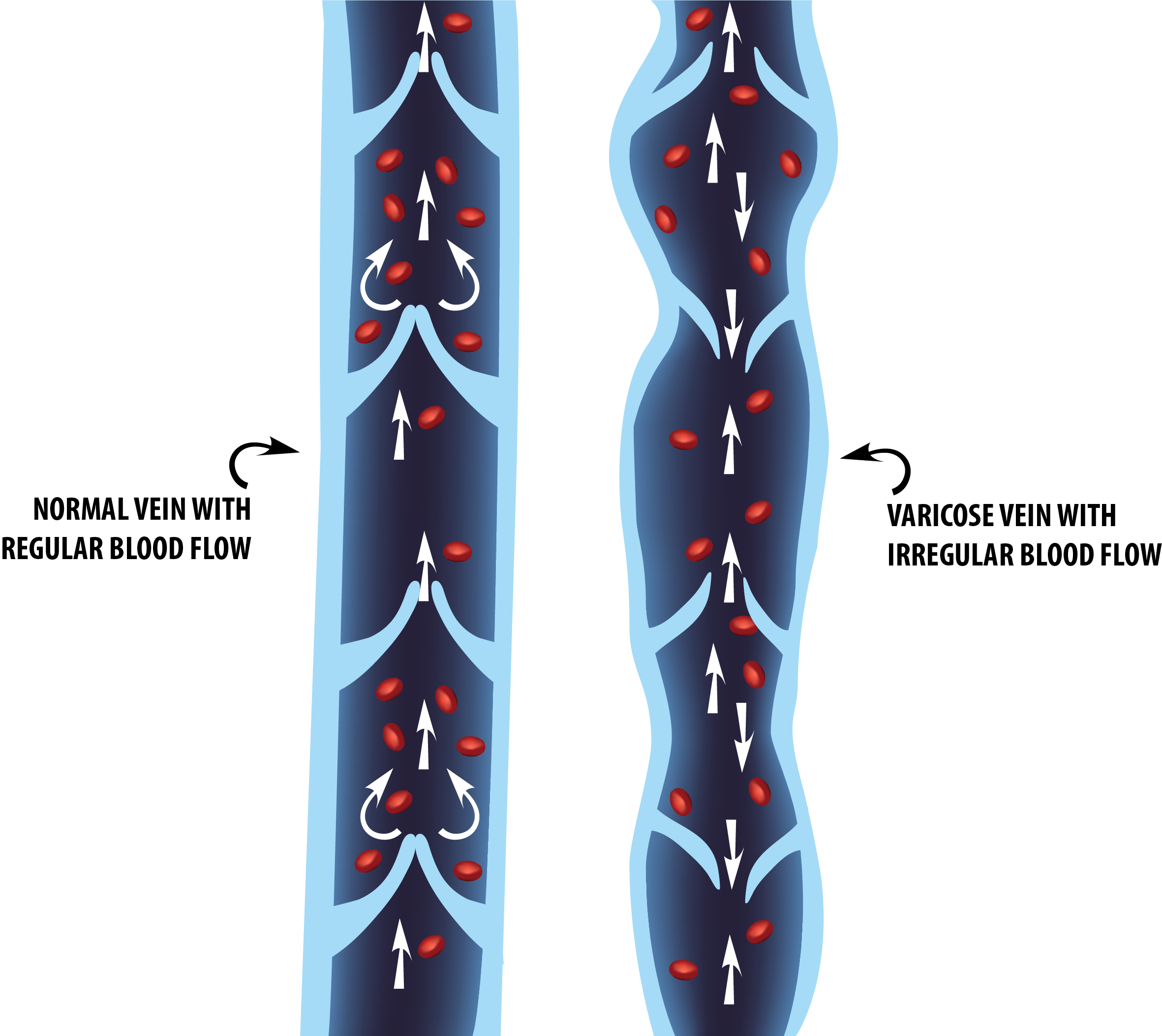 This illustration shows the difference between blood flow in a normal vein as opposed to a varicose vein, where blood flow is hindered.