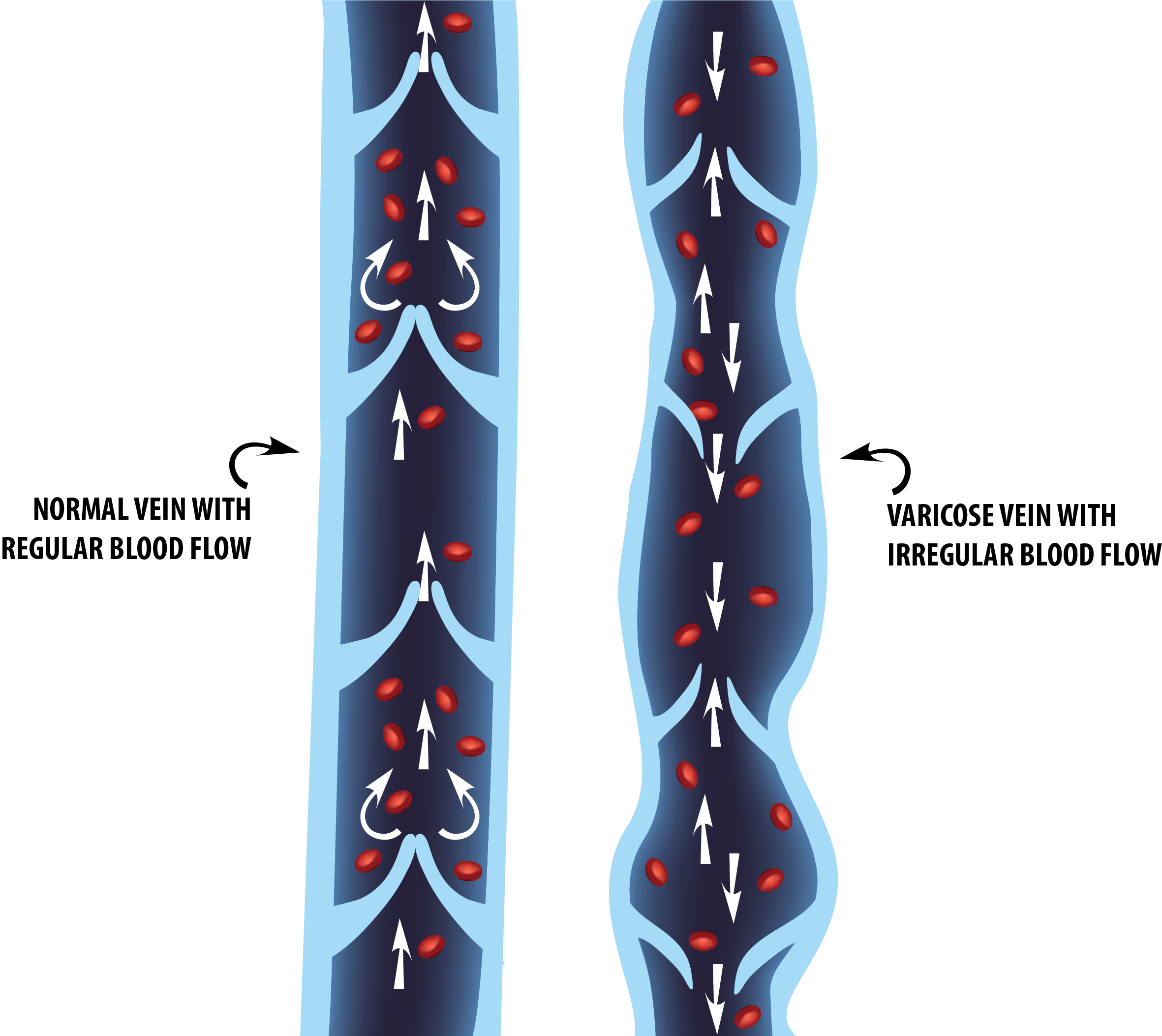 This illustration shows the difference between blood flow in a normal vein as opposed to a varicose vein, where blood flow is hindered.